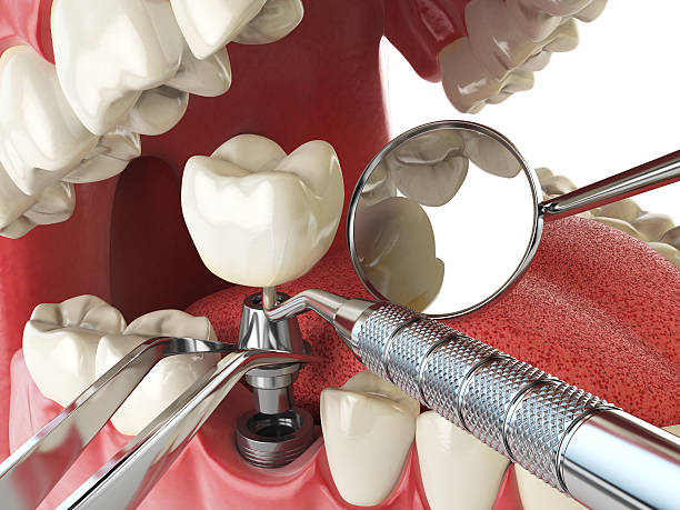 Best Emergency Treatment for Dental Infections or Abscesses in Comstock Park, MI